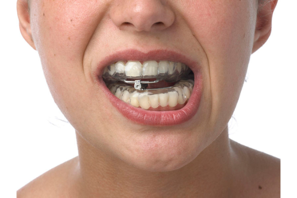 Dispositivos de avance mandibular en el tratamiento del síndrome